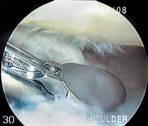 shouldersurgery17
